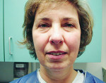 Rhytidectomy (Facelift Surgery)