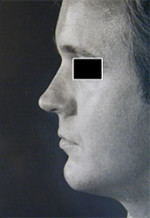 Rhinoplasty (Nasal Surgery)
