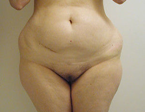 Liposuction