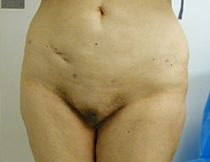 Liposuction