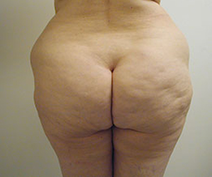 Liposuction