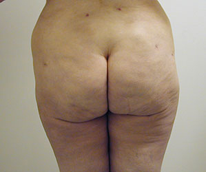 Liposuction