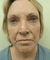 Facial Fillers (Laser)
