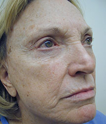Facial Fillers (Laser)