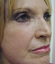Facial Fillers (Laser)