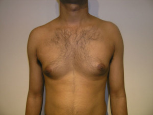 Gynecomastia (Male Breast)