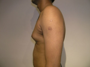 Gynecomastia (Male Breast)