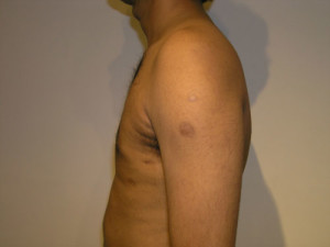 Gynecomastia (Male Breast)
