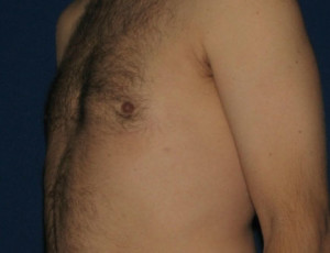 Gynecomastia (Male Breast)