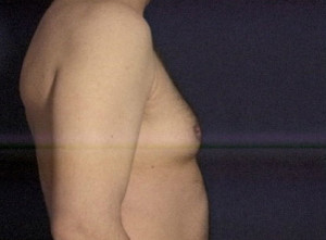 Gynecomastia (Male Breast)