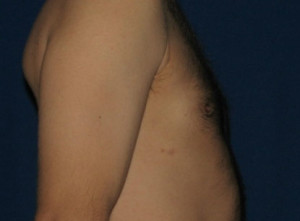 Gynecomastia (Male Breast)