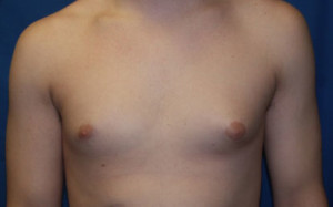 Gynecomastia (Male Breast)