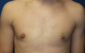 Gynecomastia (Male Breast)