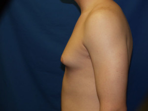 Gynecomastia (Male Breast)