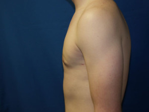 Gynecomastia (Male Breast)